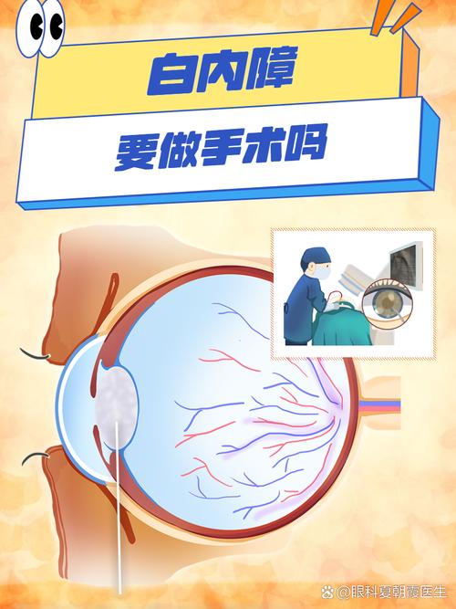 白內(nèi)障是否需要手術(shù)只需要看視力水平嗎？