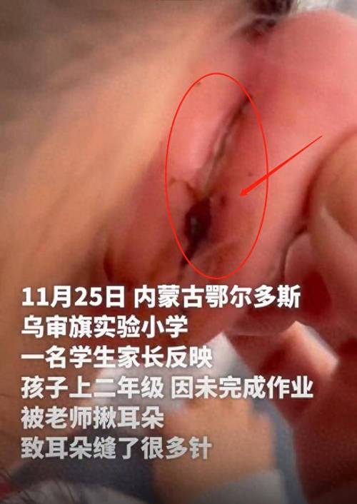 一年級女生課堂上“走神”被老師揪傷耳朵縫5針；教育局：涉事者已被停課